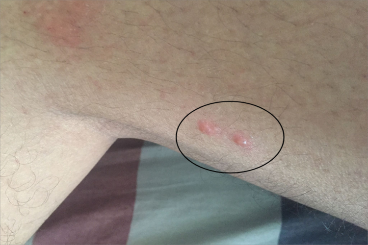 特应性皮炎大腿小水疱图