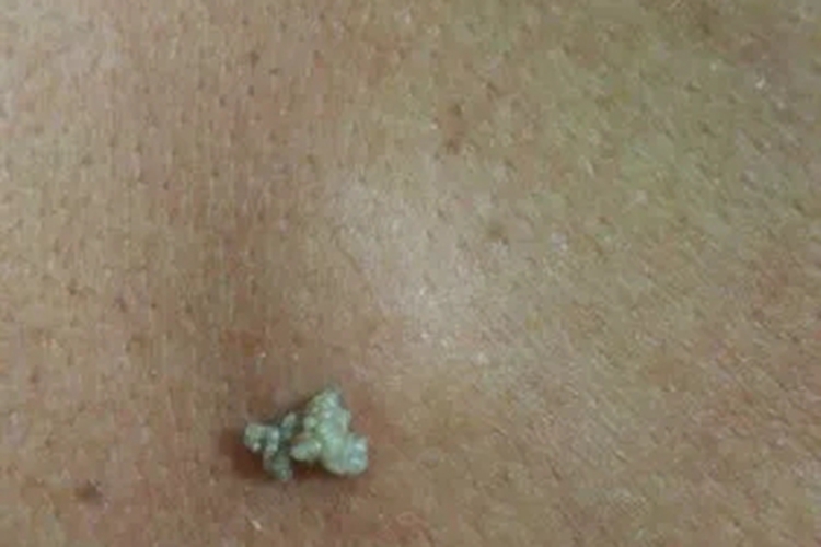皮脂腺囊肿挤出白色絮状物图 皮脂腺囊肿挤出白色絮状物图