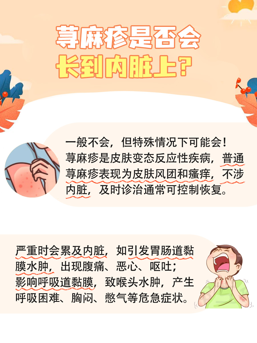 荨麻疹会长到内脏上吗？一文解答