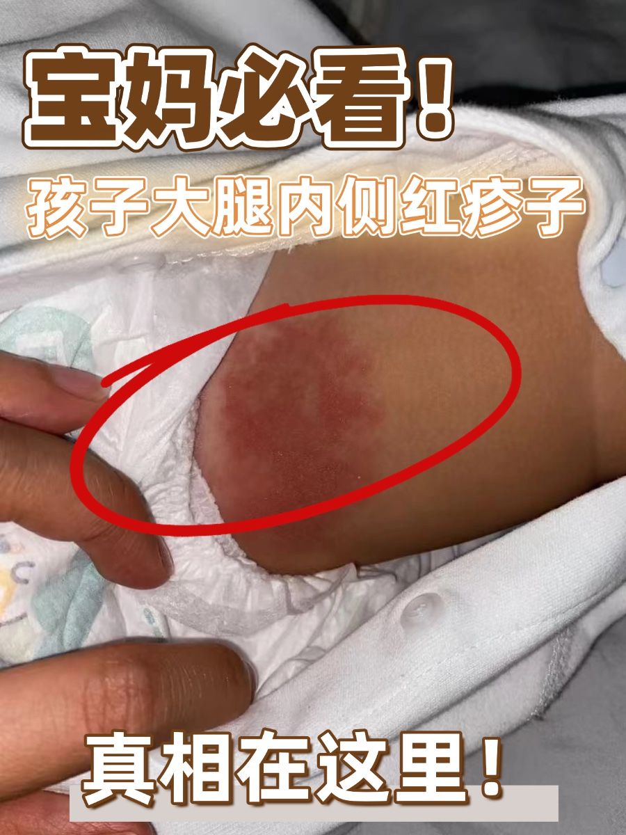 宝妈必看！孩子大腿内侧红疹子，真相在这里！