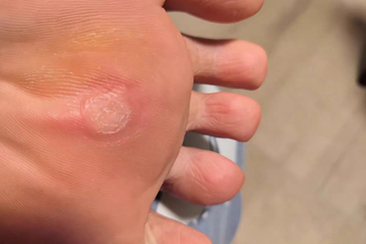 胼胝脚底有发黄发白的硬块图