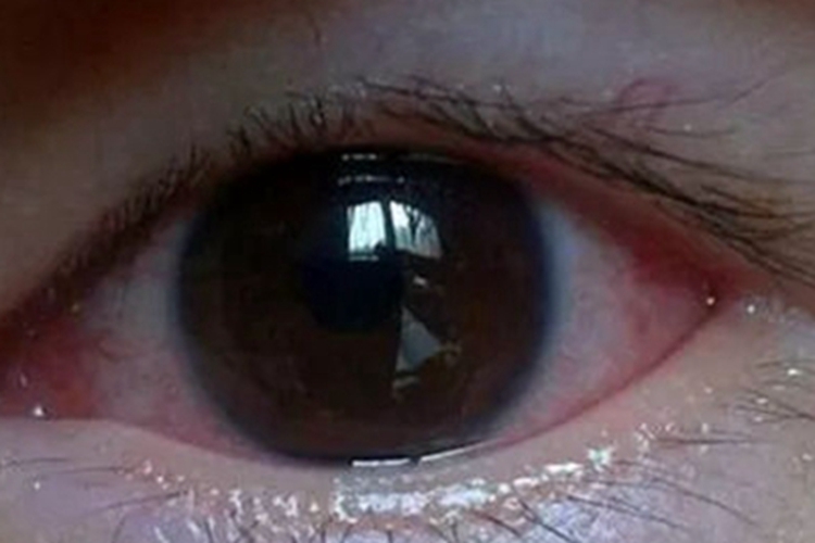 泪腺炎眼睛有红血丝图