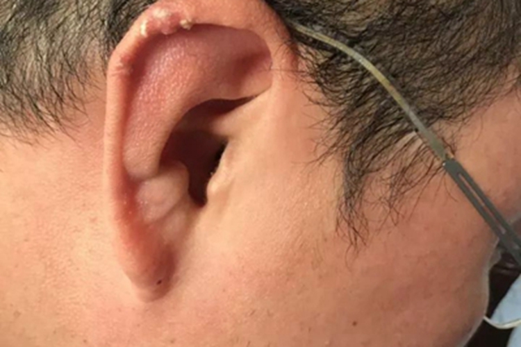 痛风耳廓长坚硬的结节图