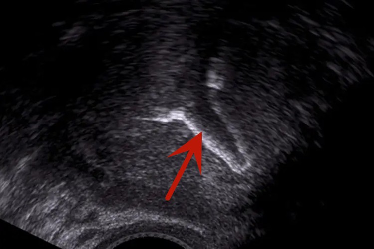 彩超显示曼月乐环正常图