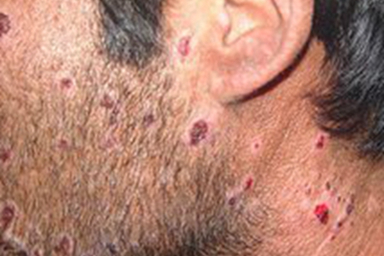 红细胞生成性原卟啉病出现疙瘩图