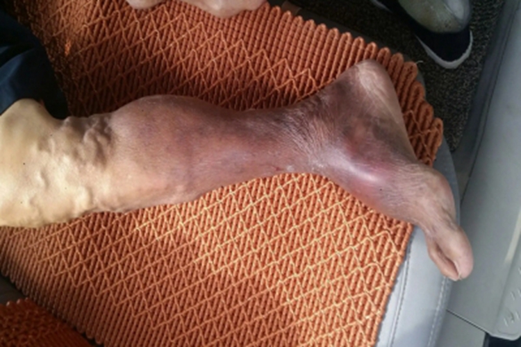 血栓闭塞性脉管炎小腿潮红图 血栓闭塞性脉管炎小腿潮红图