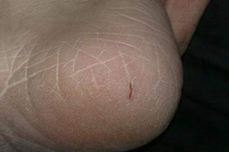 手足皲裂出血图