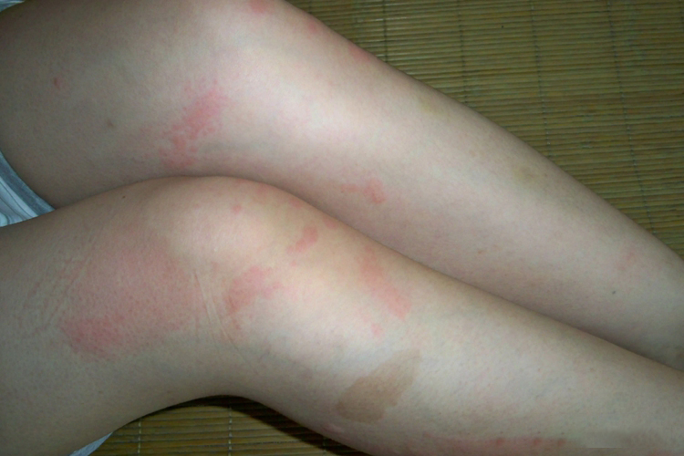 碘伏过敏症状图