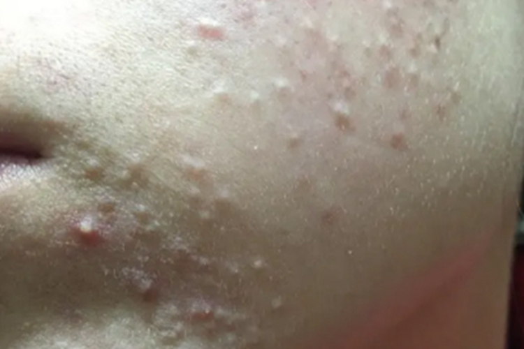 痤疮脸上长小米粒疙瘩图 痤疮脸上长小米粒疙瘩图