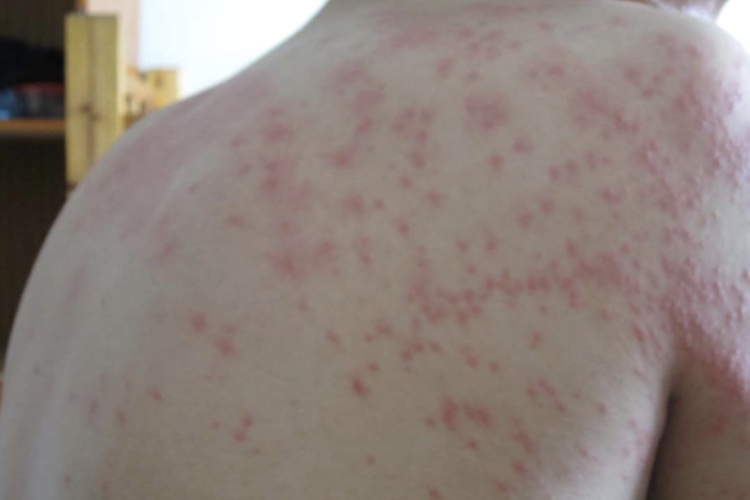 躯干风疹图