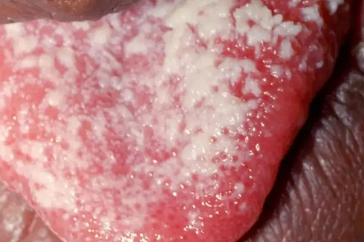 口腔念珠菌病舌苔发白图