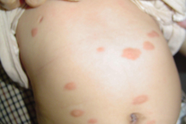 色素性荨麻疹大红疙瘩图 色素性荨麻疹大红疙瘩图