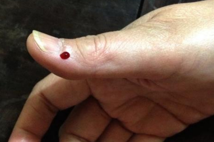 肝火旺手指放血位置图片