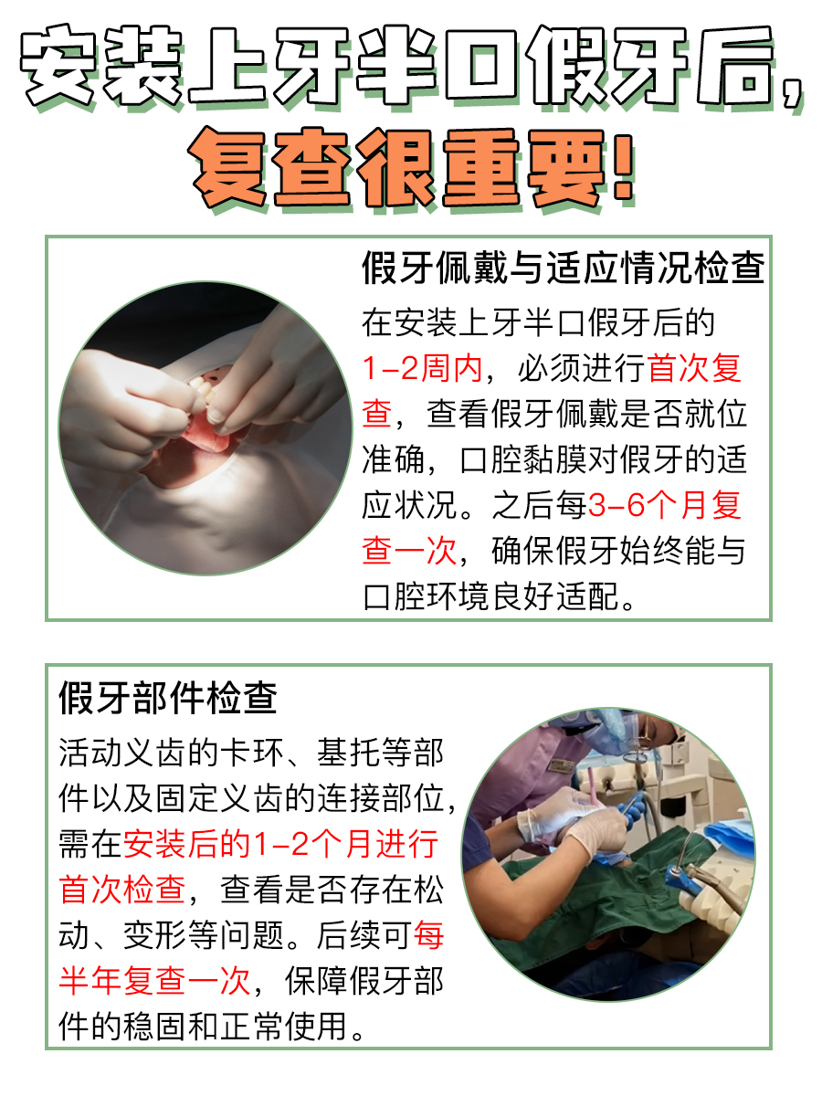 上牙半口假牙固定,门道在此!