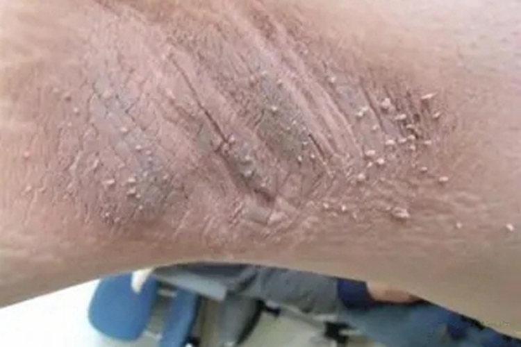 恶性黑棘皮病小疙瘩图