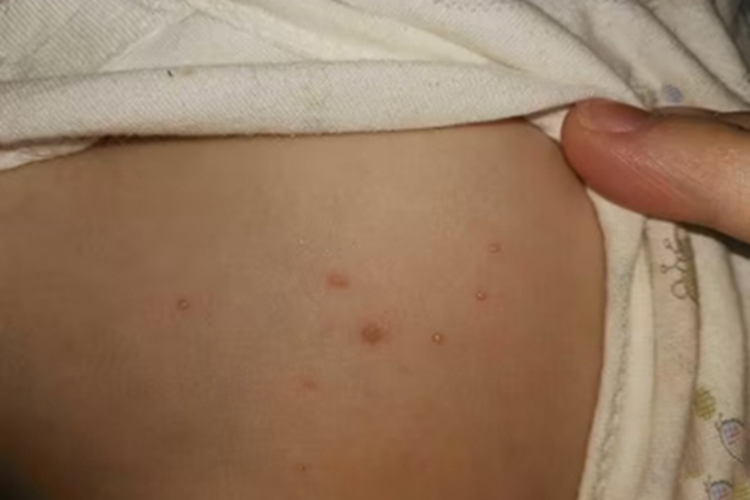 新生儿红斑后背有小水疱图