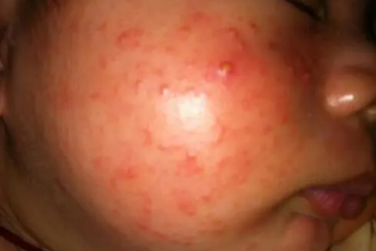 小孩烂脸痤疮图