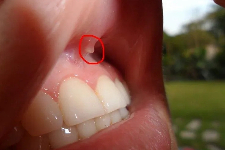 上嘴唇里边瘢痕组织图