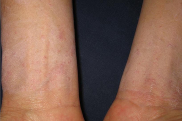 疱疹型癣菌疹胳膊丘疹图 疱疹型癣菌疹胳膊丘疹图