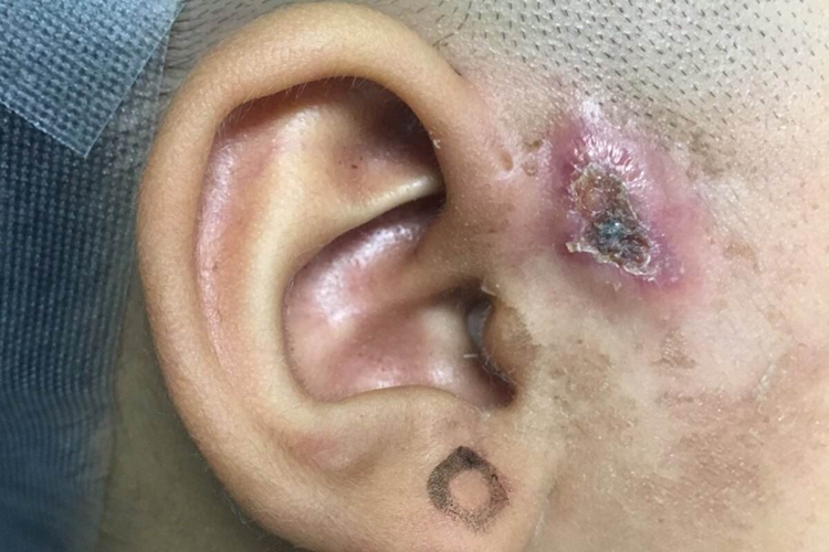 耳瘘继发感染图