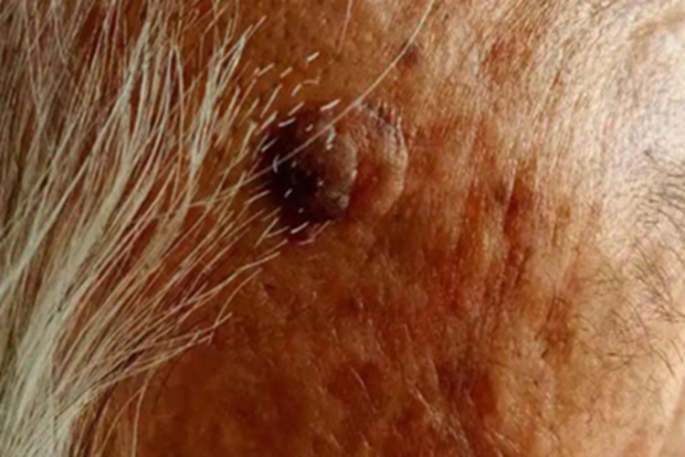 光化性角化病额头有硬疙瘩图 光化性角化病额头有硬疙瘩图