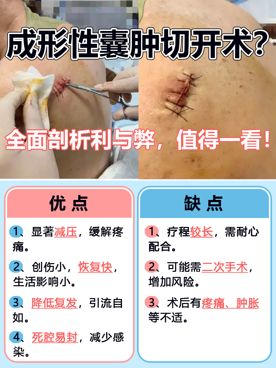 成形性囊肿切开术？全面剖析利与弊，值得一看！