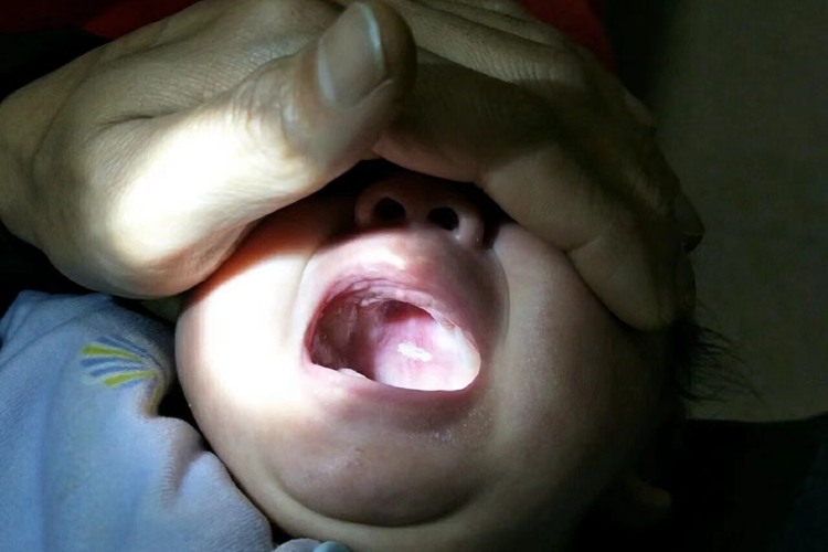 重型阿弗他溃疡图 重型阿弗他溃疡图