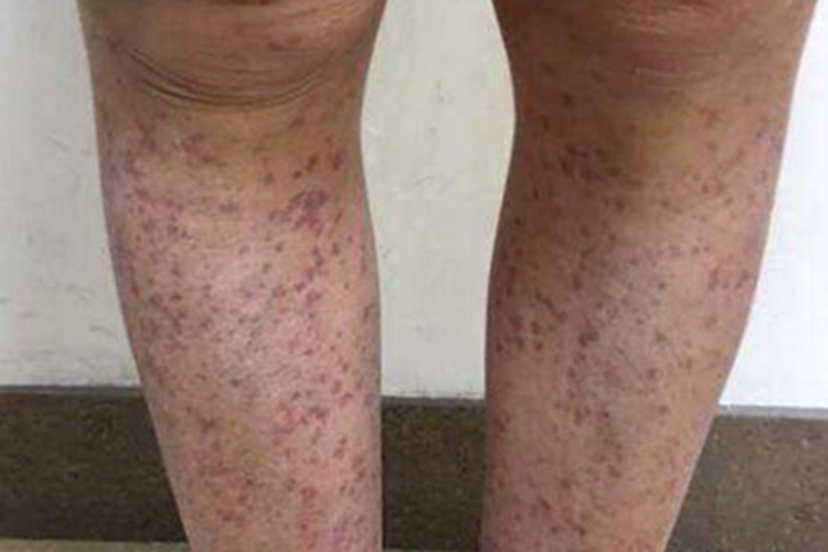 过敏性紫癜小腿有很多紫斑图