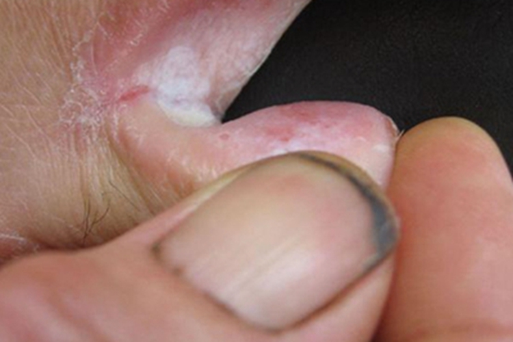 艾滋病脚趾缝白斑图 艾滋病脚趾缝白斑图