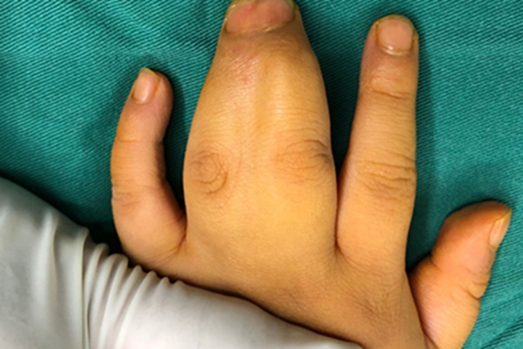 并指畸形左手连接图