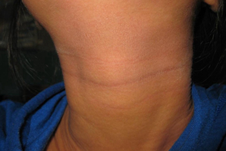 特应性皮炎长纹图