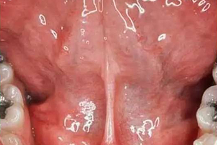 正常口腔黏膜图