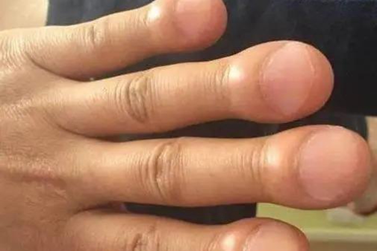 肺癌杵状指指甲图