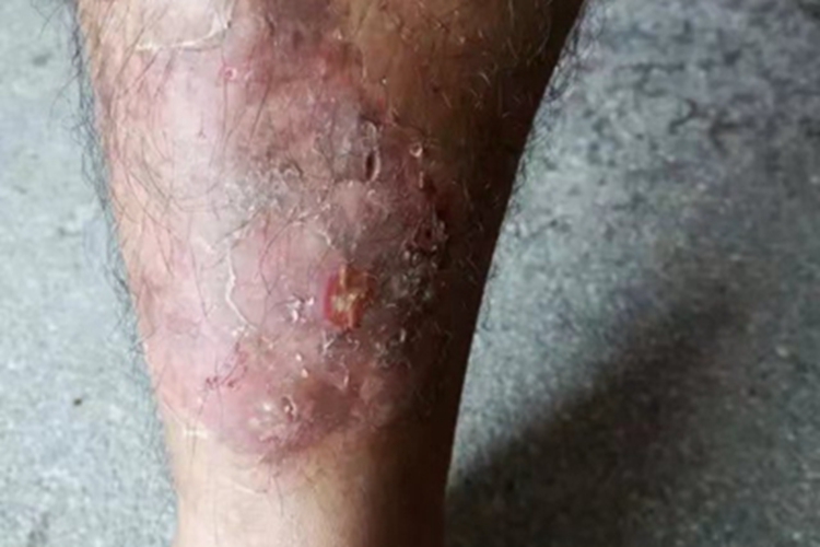 亚急性湿疹小腿前面有斑片图
