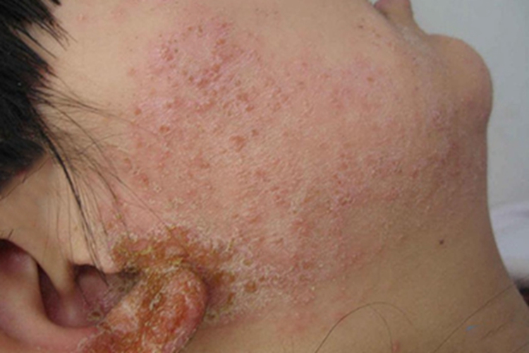 亚急性湿疹耳周糜烂图