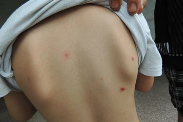 脓疱疮背部症状图