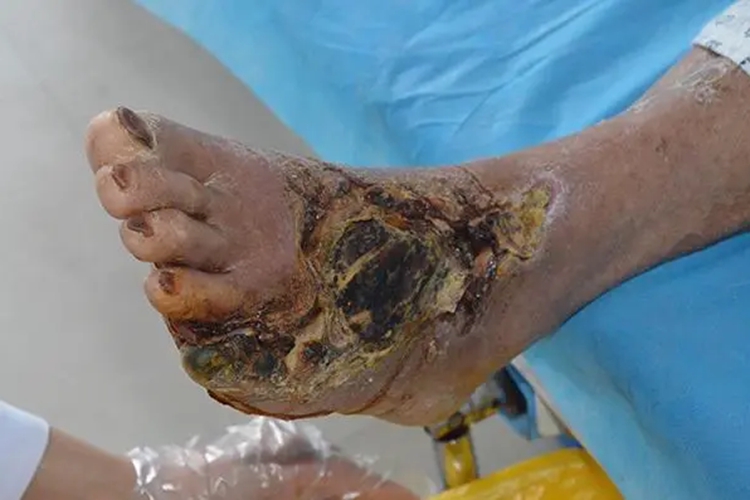 V级糖尿病足症状图