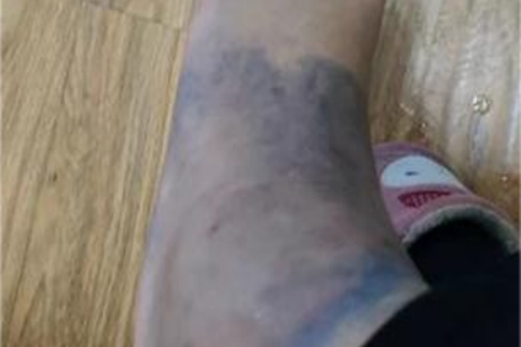 踝扭伤脚踝大面积发紫图