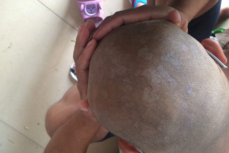 头癣愈后白印子图