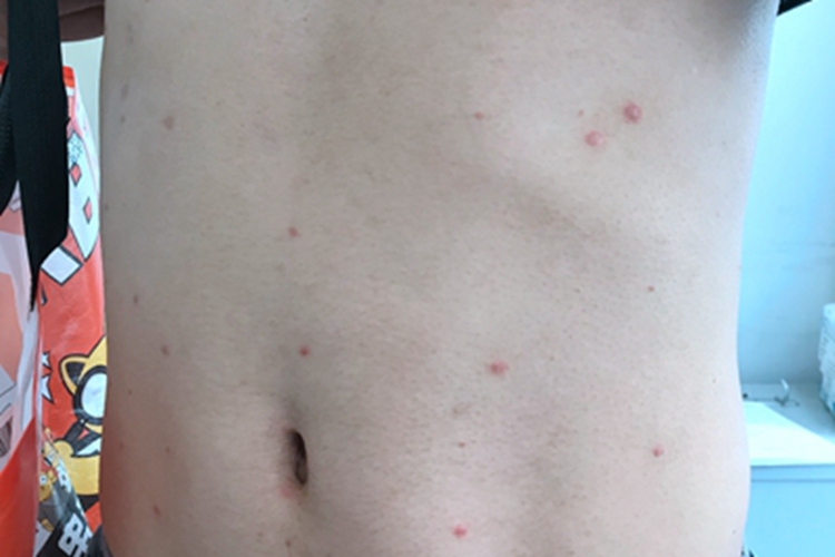 点滴型副银屑病腹部症状图