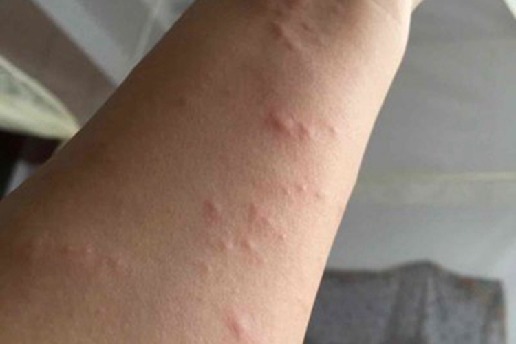 胆碱能性荨麻疹胳膊丘疹图 胆碱能性荨麻疹胳膊丘疹图