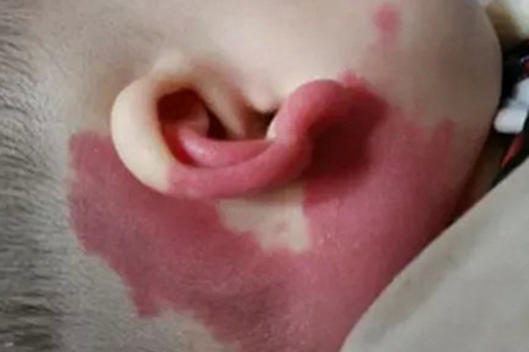 鲜红斑痣耳后红斑图