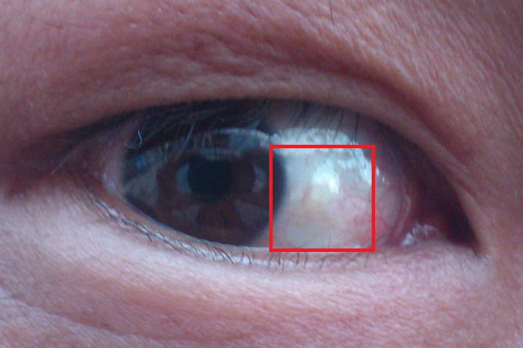 结膜囊肿白色疙瘩图 结膜囊肿白色疙瘩图