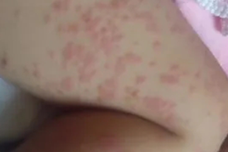 婴儿米粉过敏腿部红疹图