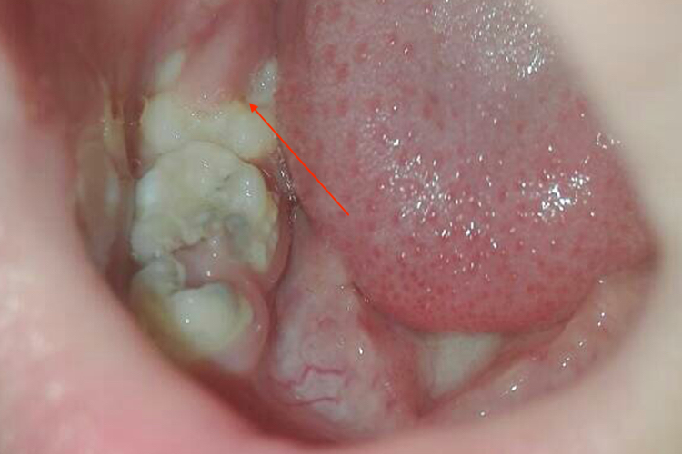 浆细胞龈炎肉芽图