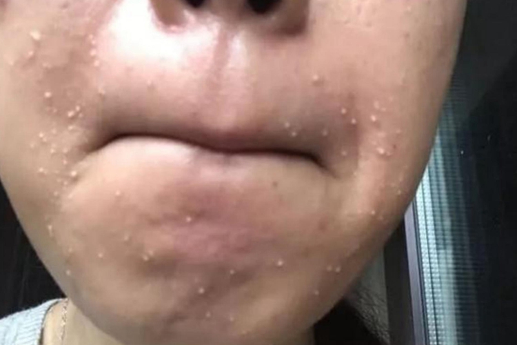 脸上有白头粉刺图