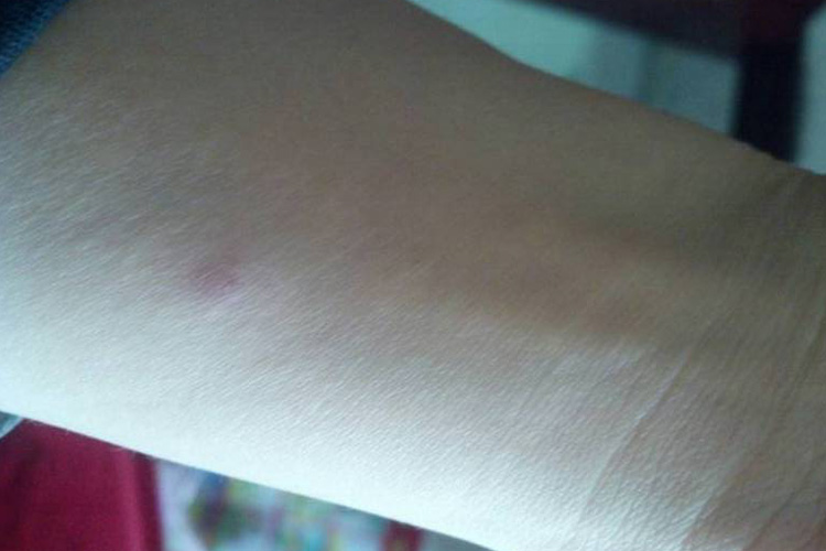 肺结核皮试第1天症状图