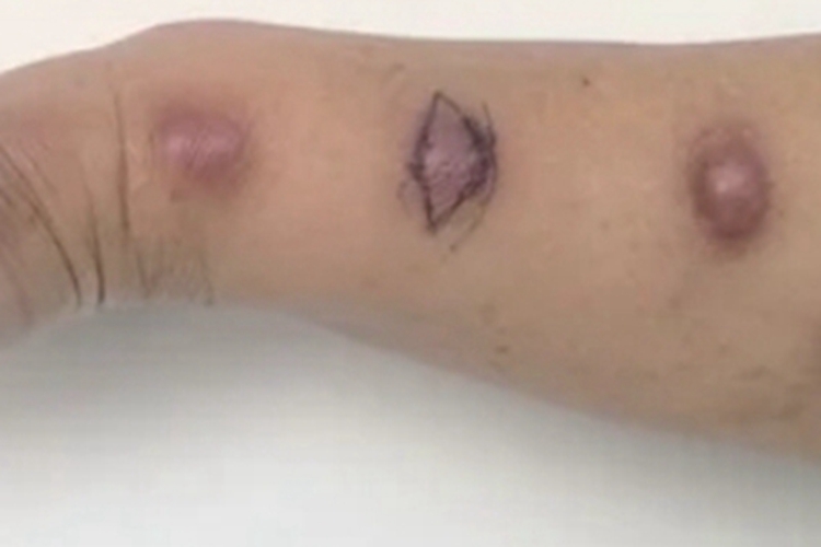 偶遇分枝杆菌感染胳膊脓肿图