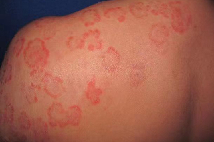 体癣肩部红斑图 体癣肩部红斑图