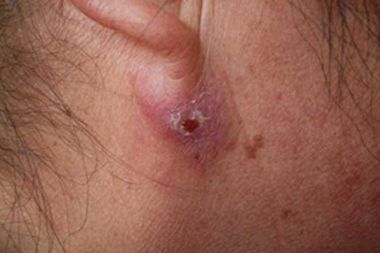 皮脂腺囊肿耳周症状图 皮脂腺囊肿耳周症状图